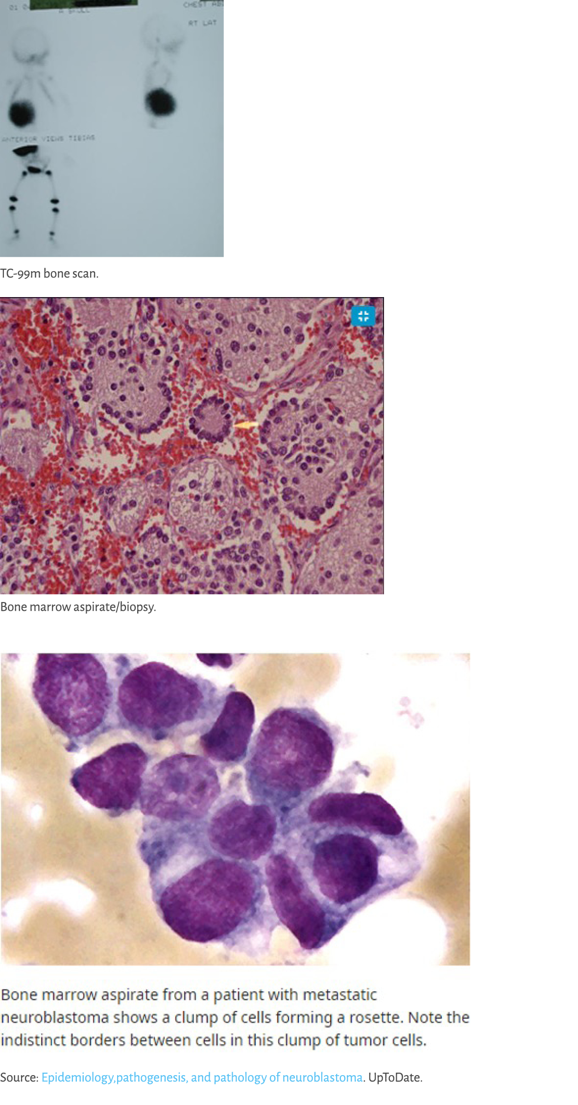 ￼ TC 99m bone scan. ￼ Bone marrow aspirate/biopsy. ￼ Source: Epidemiology,pathogenesis, and pathology of neuroblastom...