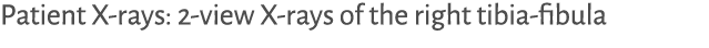 Patient X-rays: 2-view X-rays of the right tibia-fibula