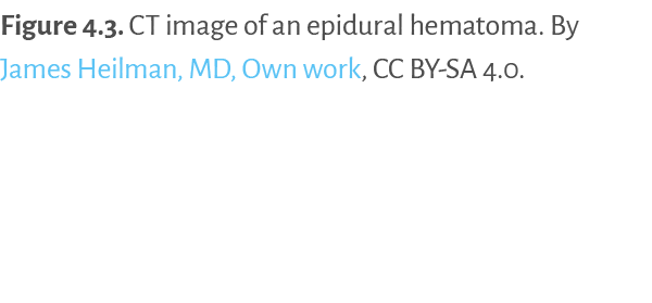 Figure 4.3. CT image of an epidural hematoma. By James Heilman, MD, Own work, CC BY SA 4.0. 