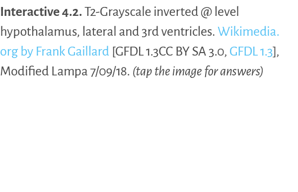 Interactive 4.2. T2 Grayscale inverted @ level hypothalamus, lateral and 3rd ventricles. Wikimedia.org by Frank Gaill...