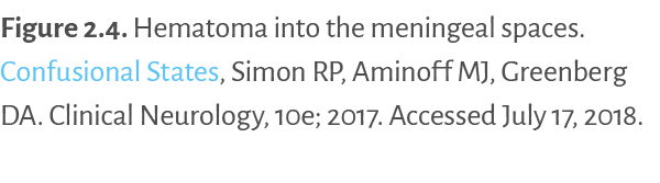 Figure 2 4   Hematoma into the meningeal spaces  Confusional States, Simon RP, Aminoff MJ, Greenberg DA  Clinical Neu   