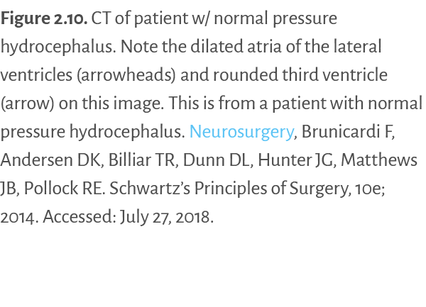 Figure 2 10  CT of patient w  normal pressure hydrocephalus  Note the dilated atria of the lateral ventricles (arrowh   