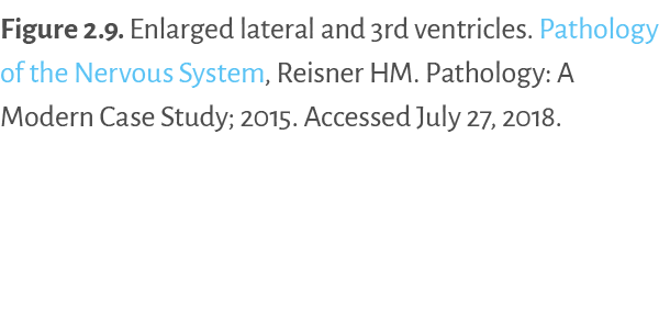 Figure 2 9   Enlarged lateral and 3rd ventricles  Pathology of the Nervous System, Reisner HM  Pathology: A Modern Ca   