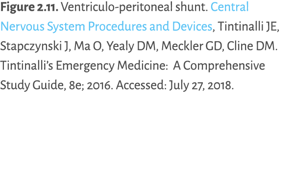 Figure 2 11  Ventriculo-peritoneal shunt  Central Nervous System Procedures and Devices, Tintinalli JE, Stapczynski J   