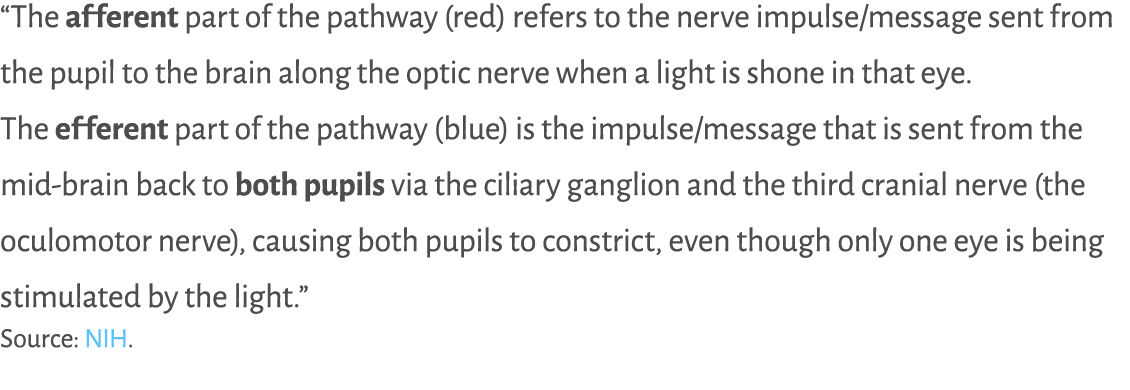 “The afferent part of the pathway (red) refers to the nerve impulse/message sent from the pupil to the brain along th...