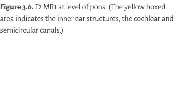 Figure 3.6. ﻿T2 MR1 at level of pons. (The yellow boxed area indicates the inner ear structures, the cochlear and sem...
