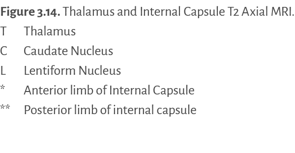 Figure 3.14. ﻿Thalamus and Internal Capsule T2 Axial MRI. T Thalamus C Caudate Nucleus L Lentiform Nucleus * Anterior...
