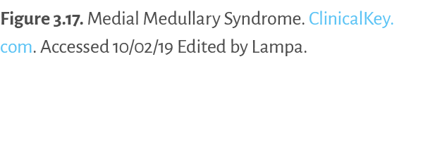 Figure 3.17. ﻿Medial Medullary Syndrome. ClinicalKey.com. Accessed 10/02/19 Edited by Lampa. 