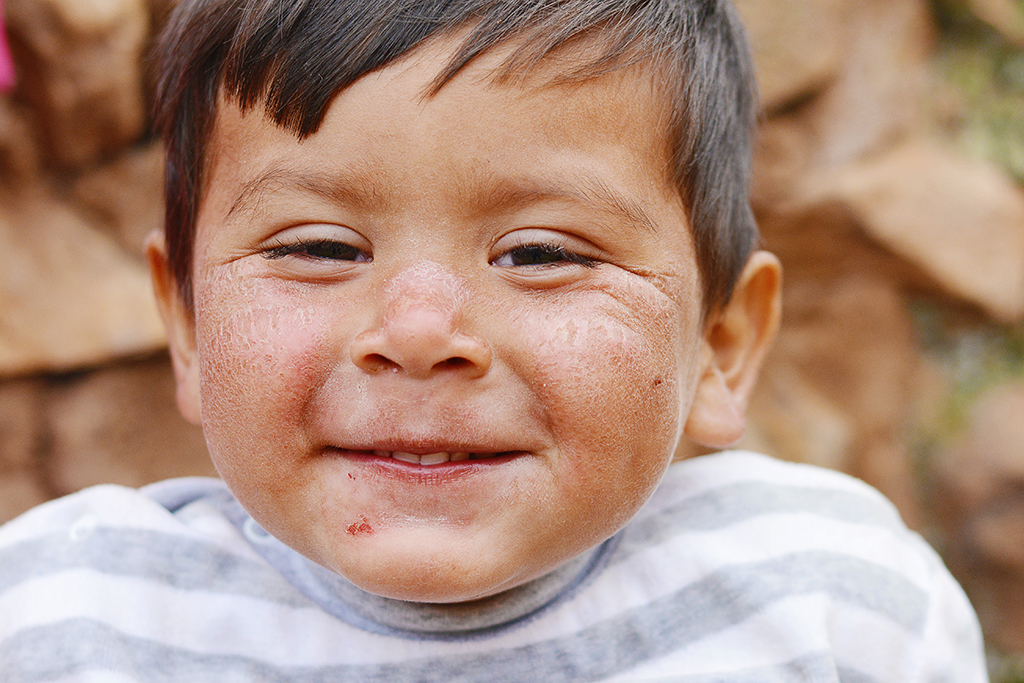 planetary-health-vector-borne-disease-child