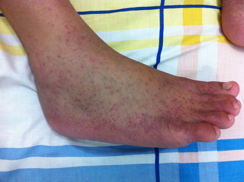 planetary-health-vector-borne-chikungunya-image