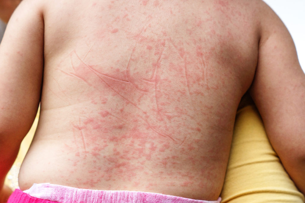 planetary-health-vector-borne-dengue-fever