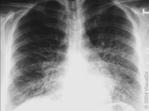 plantary-health-vector-borne-hantavirus-lungs