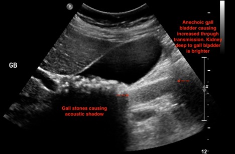 ultrasound-gall-bladder-stones-image