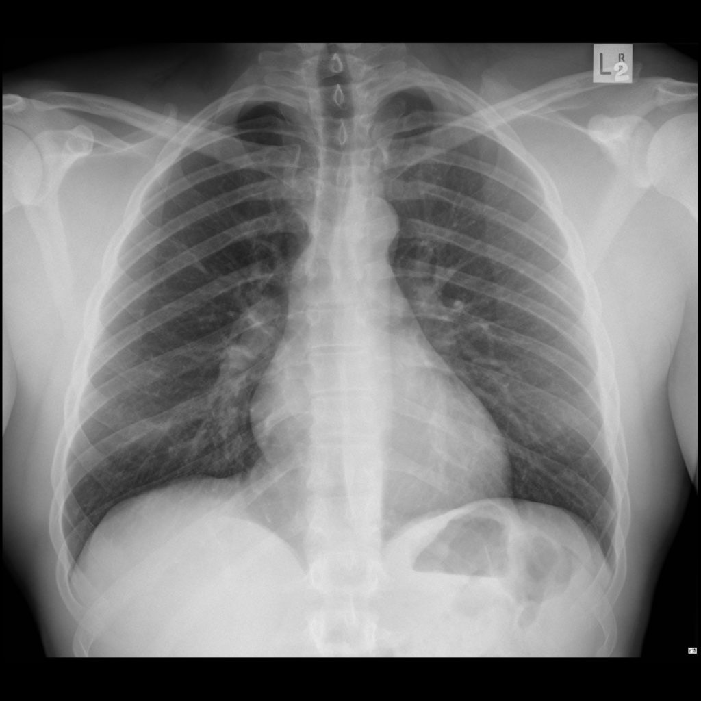 xray-chest-PA-image