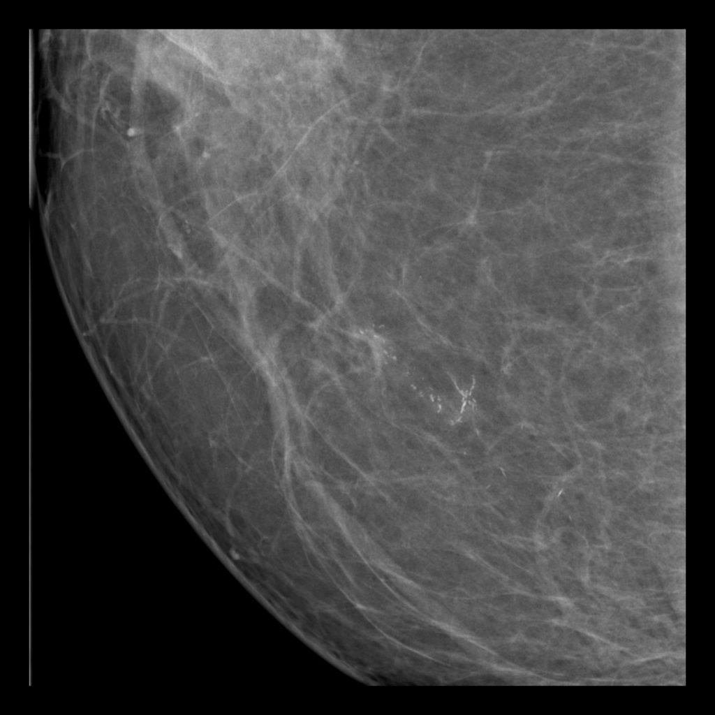 x-ray-malignant breast-calcification-image
