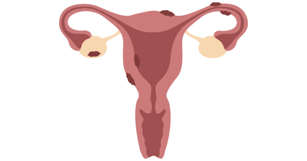 dysmenorrhea-endometriosis-featured-image