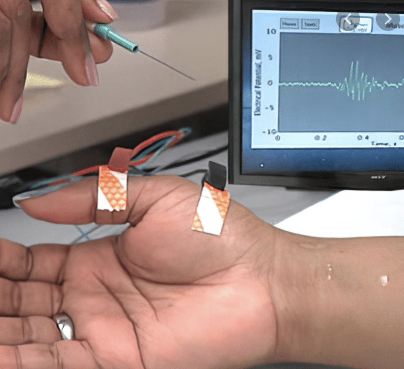 An EMG involves inserting a thin needle electrode into a muscle . . .