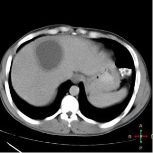 liver-abcess-ct-imaging