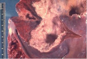 parasitology-case-study-ms-xiu-pathology-liver-image