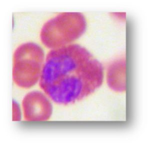 eosinophilia-image