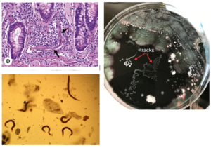 strongyloides-stercoralis-diagnosis-images