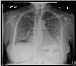 strongyloides-stercoralis-late-infection-clinical-xray