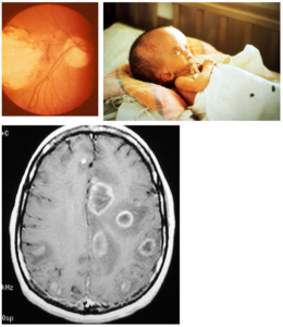 parasitology-toxoplasmosis-clinical-images