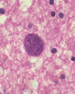 toxoplasmosis-diagnosis-histology-image