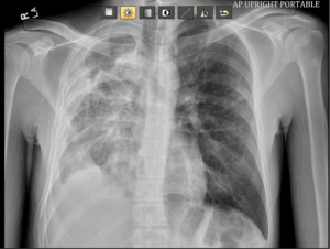 Case Study Chest X-ray 2