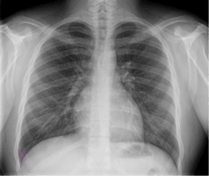 Chest X-ray