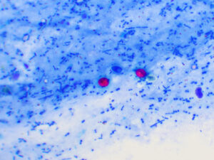 Red shapes show Cryptosporidiosis.