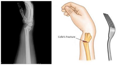 Figure 10.11 Dinner fork deformity.