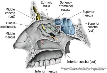 Figure 34.15. Routes of paranasal sinus drainage to nasal cavity. Yellow: Frontal; Green: Ethmoidal cells; Blue: Sphenoidal; Orange: Maxillary; Red: Nasolacrimal duct.