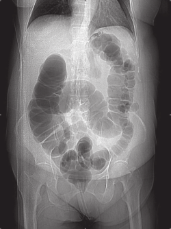 Figure 12. Supine scout image of CT colonography—colon inflated with air—haustra are shown as contiguous rectangular pouches. HTTPS://WWW.RESEARCHGATE.NET/.