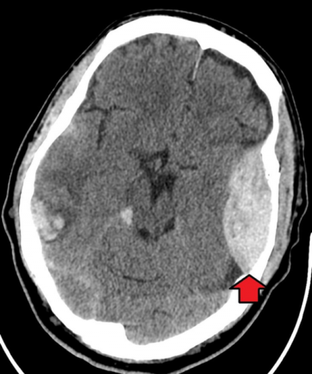 Figure 4.3. CT image of an epidural hematoma. By James Heilman, MD, Own work, CC BY-SA 4.0.