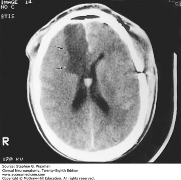Figure 5.8. Anterior cerebral artery infarct. Vascular Supply of the Brain, Waxman SG. Clinical Neuroanatomy, 28e; 2017. Accessed: July 25, 2018.
 Signs/symptoms of patient from CT image (R. anterior cerebral artery)