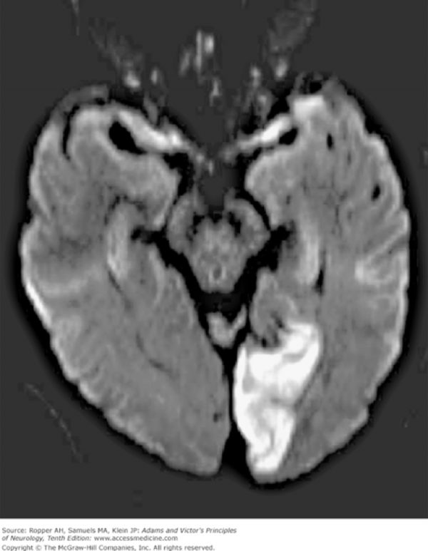Figure 5.9. Posterior cerebral artery infarct. Chapter 34. Cerebrovascular Diseases, Ropper AH, Samuels MA, Klein JP. Adams and Victor’s Principles of Neurology, 10e; 2014. Accessed: July 25, 2018.


 Signs/symptoms of patient from CT scan (L. posterior cerebral artery)