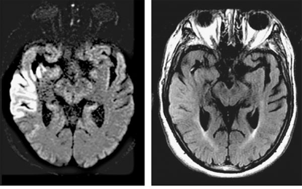 Figure 5.10. Middle cerebral artery infarcts. Chapter 34. Cerebrovascular Diseases, Ropper AH, Samuels MA, Klein JP. Adams and Victor’s Principles of Neurology, 10e; 2014. Accessed: July 25, 2018.

 Signs/symptoms of a patient with R. middle cerebral artery infarct