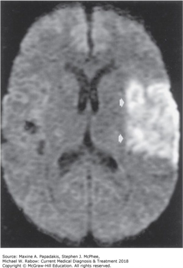 Figure 5.11. (left) Nervous System Disorders, Papadakis MA, McPhee SJ, Rabow MW. Current Medical Diagnosis & Treatment 2018; 2017. Accessed: July 25, 2018.


 Signs/symptoms of patient from CT scan (L. middle cerebral artery)