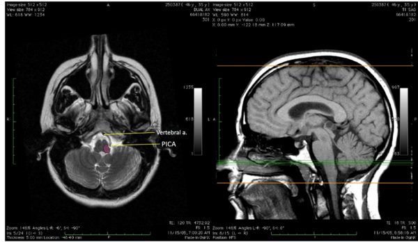 Figure 5.12. Posterior inferior cerebellar artery infarct. T2-weighted MRI through rostral medulla, both the vertebral and posterior inferior cerebellar arteries are labeled. From Neuroanatomy Image Archive, Washington State University College of Veterinary Medicine.



 Signs/symptoms of a patient with an infarct in the region highlighted (hint: this is lateral medullary syndrome)